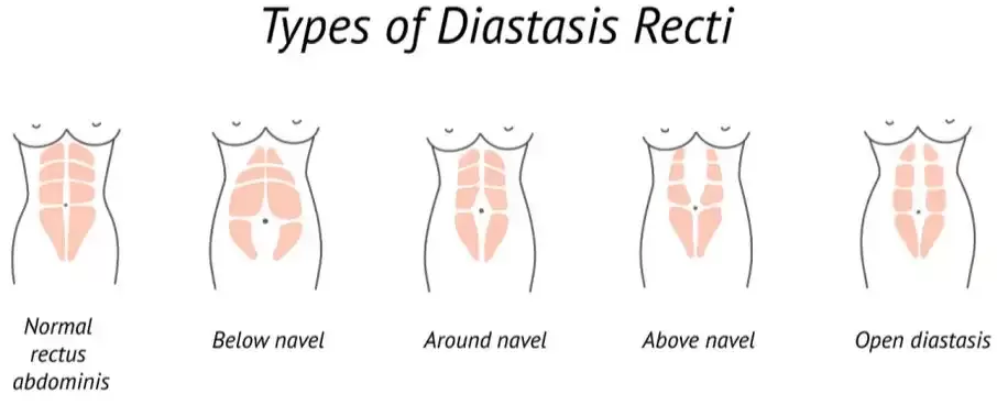 Why You Shouldn't Ignore Diastasis Recti